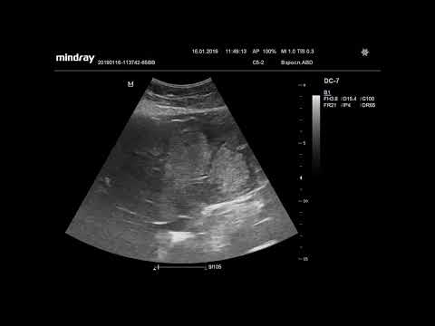 Видео: УЗИ. Доктор Иогансен. Видеопримеры.  Выпуск 2. Метастазы в печени. Часть 2.