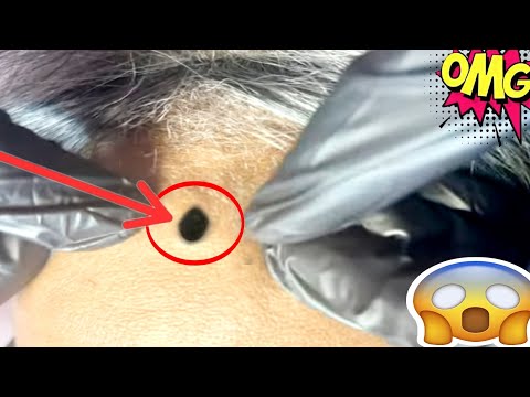 Видео: удаление черных точек | удаление черных точек |