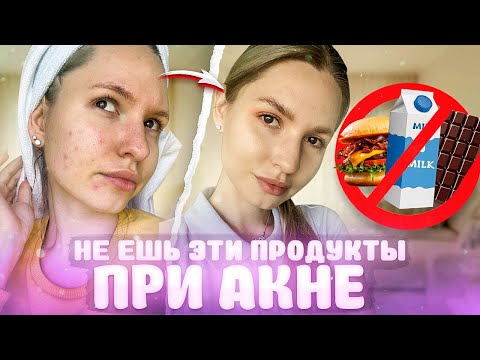 Видео: ПИТАНИЕ ПРИ ПРЫЩАХ | КАК ИЗБАВИТЬСЯ ОТ АКНЕ