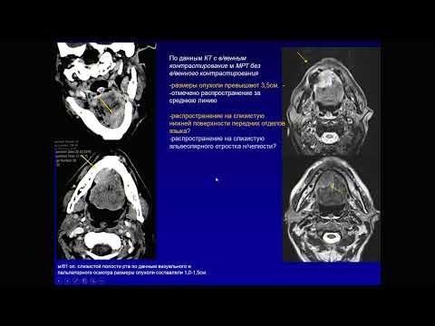 Видео: Опухоли полости рта и ротоглотки 2