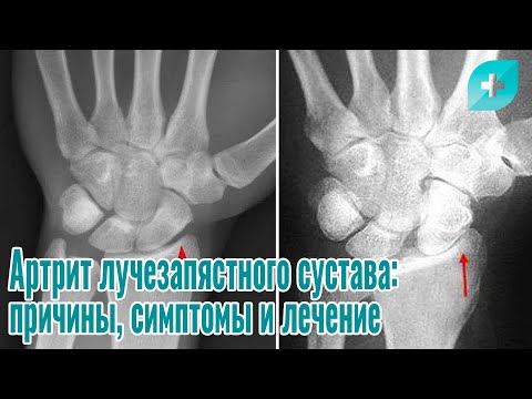 Видео: Артрит лучезапястного сустава:причины, симптомы и лечение