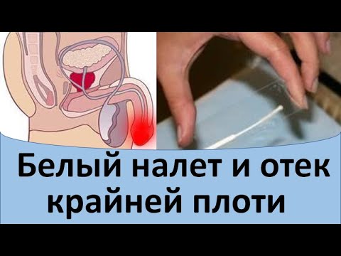 Видео: Белый налет и отек крайней плоти