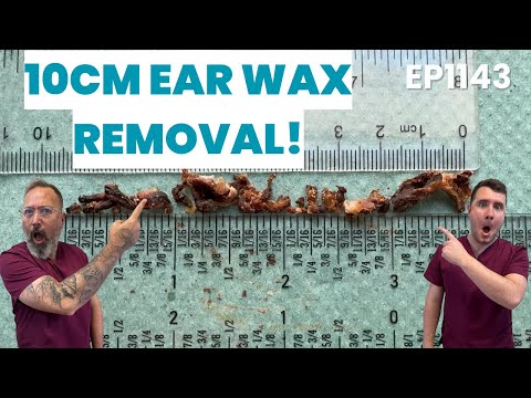Видео: 🎥 МЕГА 10 см для удаления ушной серы – полное и приятное удаление! 👂✨ EP1143