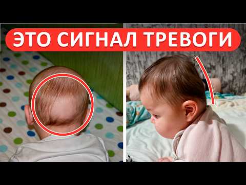 Видео: ТАКОЙ череп у малыша НЕ норма! / Чем ОПАСЕН плоский затылок у ребенка?