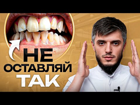 Видео: Самый ОПАСНЫЙ вид прикуса, который есть у 70% населения! Как исправить дистальный прикус