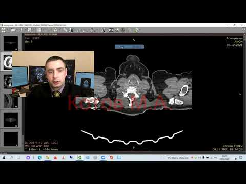 Видео: Центральный рак легкого. Ролик № 11.
