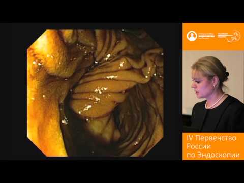 Видео: Крупная нейроэндокринная опухоль вертикального отдела двенадцатиперстной кишки