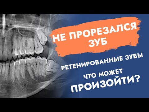 Видео: Не прорезался зуб. Ретенированные зубы.