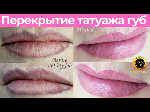 Видео: Перекрытие татуажа губ. Лазерное удаление татуажа губ и удаление ремувером
