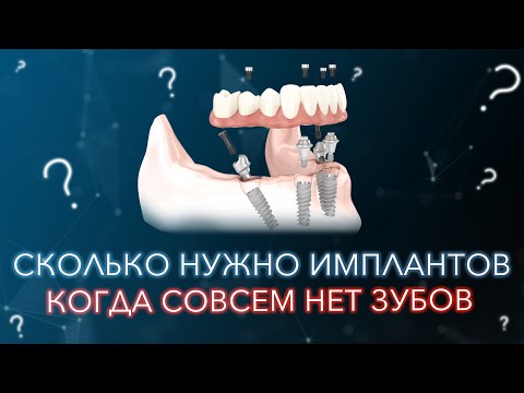 Видео: Вообще нет зубов. Сколько нужно имплантов.