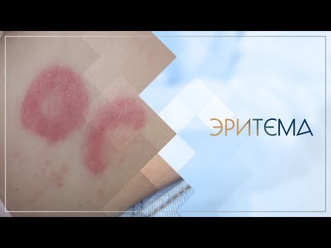 Видео: 😐 Эритема