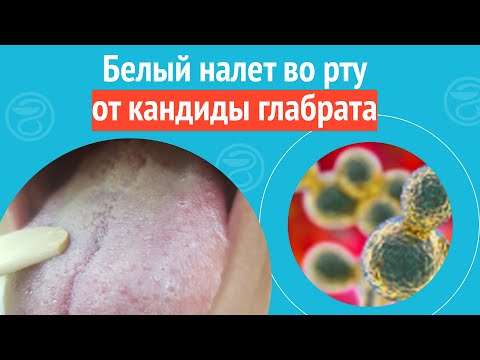Видео: 👅 Белый налет во рту от кандиды глабрата. Клинический случай №1677