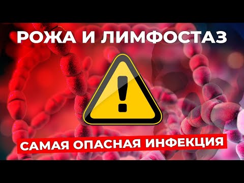 Видео: РОЖА: почему возникает при отеке и чем рискует пациент с лимфостазом