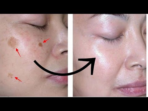 Видео: ПЕЧЕНОЧНЫЕ ПЯТНА. Как избавиться от пятен на коже?