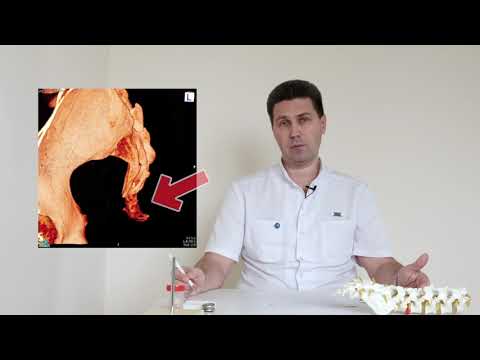 Видео: 9 главных вопросов о болях в копчике