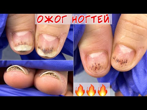 Видео: Ожог ногтевой пластины 🔥 / Как убрать утолщенный ноготь?
