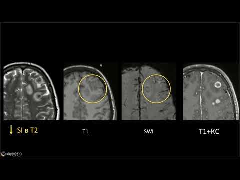 Видео: Метастазы в головной мозг много лиц одного процесса