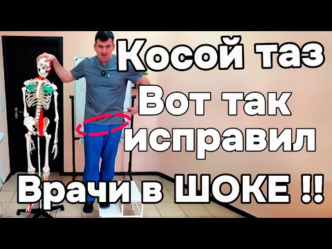 Видео: Врачи в ШОКЕ! Я исправил КОСОЙ ТАЗ и теперь порхаю как бабочка и жаль что я не знал раньше