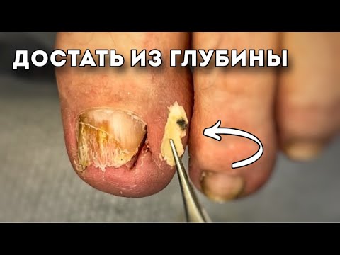 Видео: Достать то, что глубоко и болит