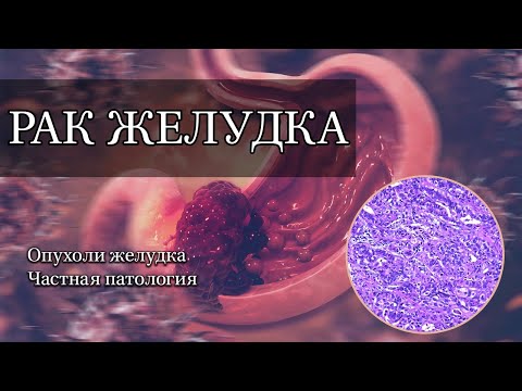 Видео: Рак желудка | Частная патология