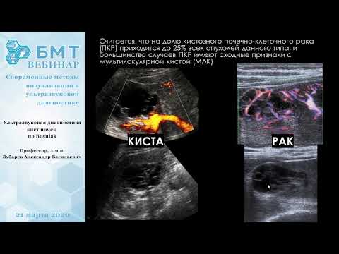 Видео: Ультразвуковая диагностика кист почек по Bosniak