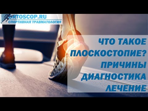 Видео: ЧТО ТАКОЕ ПЛОСКОСТОПИЕ? ПРИЧИНЫ. ДИАГНОСТИКА. ЛЕЧЕНИЕ