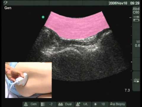 Видео: УЗИ седалищного нерва