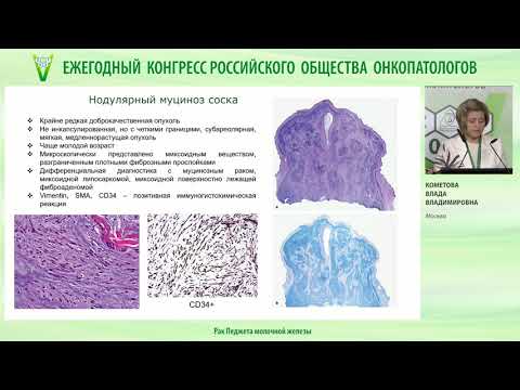 Видео: Рак Педжета молочной железы
