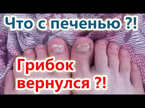 Видео: ОТВЕТЫ на ВОПРОСЫ лечение грибка ногтей
