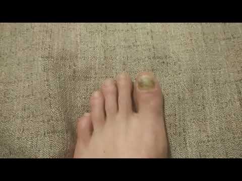 Видео: Отбитый ноготь на ноге часть 5 без докторов