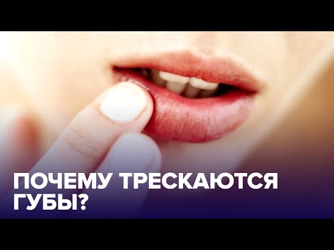 Видео: Почему ТРЕСКАЮТСЯ губы? Причины и что с этим делать