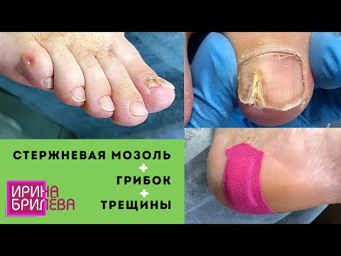 Видео: Стержневая мозоль удаление 🌸 Грибок ногтей 🌸 Трещины 🌸 Очень много работы 🌸 Педикюр 🌸 Ирина Брилёва