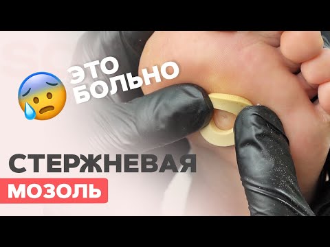 Видео: Удаляем стержневую мозоль | Три способа разгрузки