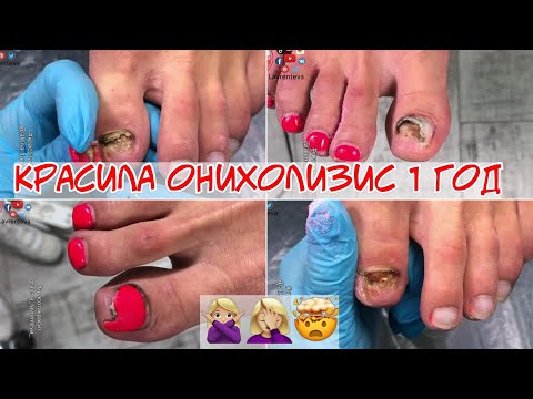Видео: Просто жесть! 🤬 Грибок ногтей на ногах 😱 Почему нельзя красить онихолизис ногтей? nail влог