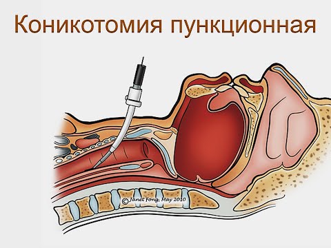 Видео: коникотомия