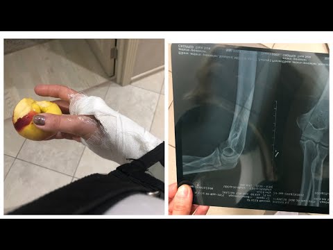 Видео: Перелом руки. Все стадии заживления. Советы переломанным. Нетрадиционные способы лечения