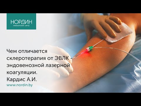 Видео: Чем отличается склеротерапия от эндовенозной лазерной коагуляции? Ответ флеболога