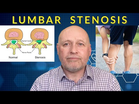 Видео: Стеноз поясничного отдела позвоночника: все, что вам нужно знать.
