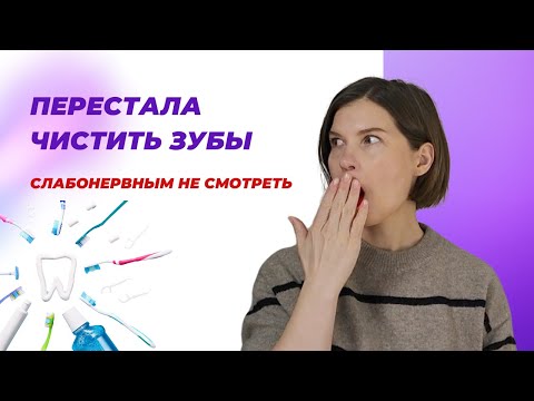 Видео: Зубной камень I Мой уход за зубами I Результаты 11-месячного эксперимента подтверждённые врачом