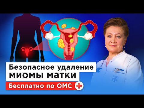 Видео: Как удалить миому, сохранив матку: эмболизация маточных артерий бесплатно по ОМС