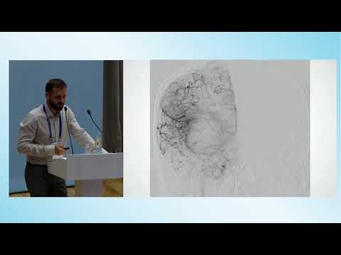Видео: Сателлитный симпозиум. 5 лет практики эндоваскулярного лечения острого ишемического инсульта