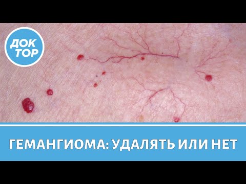 Видео: Главные правила профилактики гемангиом