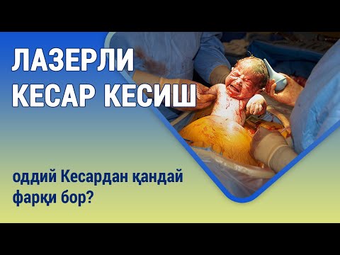 Видео: Лазерли кесар кесиш. Оддий Кесардан қандай фарқи бор?