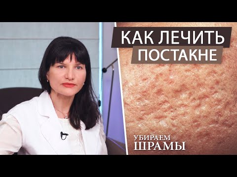 Видео: Как лечить постакне. Убираем рубцы и шрамы. Правильный уход за кожей