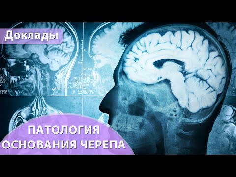 Видео: Патология основания черепа. Андрей Мангов