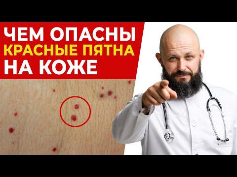 Видео: Появляются красные родинки — что это такое и как их убрать?