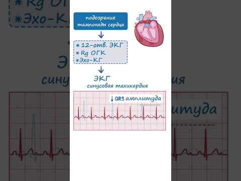 Видео: Тампонада сердца ЭКГ признаки