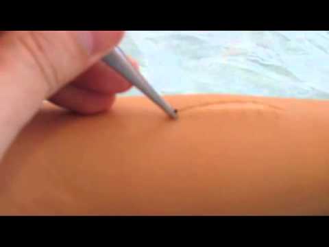 Видео: Техника снятия кожного шва