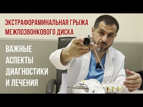 Видео: Экстрафораминальная грыжа межпозвонкового диска - особенности диагностики и лечения.