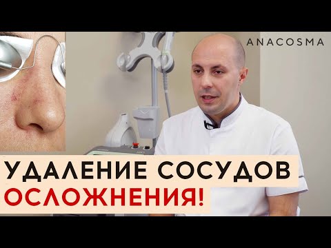 Видео: 🆘 УДАЛЕНИЕ СОСУДОВ ЛАЗЕРОМ ❗❗❗ ОСЛОЖНЕНИЯ